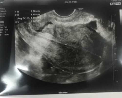 国内供卵生宝宝价格,试管胎停清宫后多久可以再次促排？听听大家怎么说